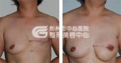 乳房再造的效果如何