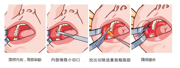 荆州哪家医院去颊脂垫效果*好？多少钱？